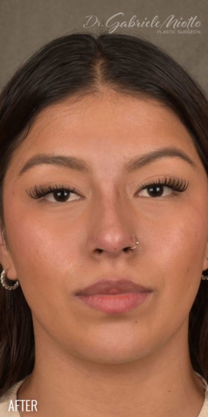 Non Surgical Rhinoplasty Before & After Patient #1313