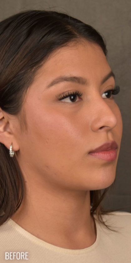 Non Surgical Rhinoplasty Before & After Patient #1313