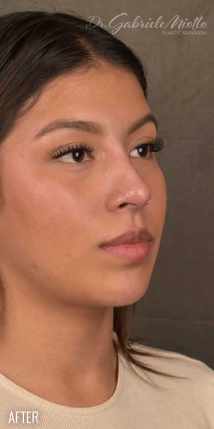 Non Surgical Rhinoplasty Before & After Patient #1313