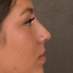 Non Surgical Rhinoplasty Before & After Patient #1313