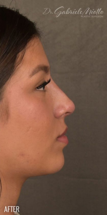 Non Surgical Rhinoplasty Before & After Patient #1313