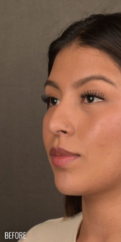 Non Surgical Rhinoplasty Before & After Patient #1313