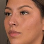 Non Surgical Rhinoplasty Before & After Patient #1313