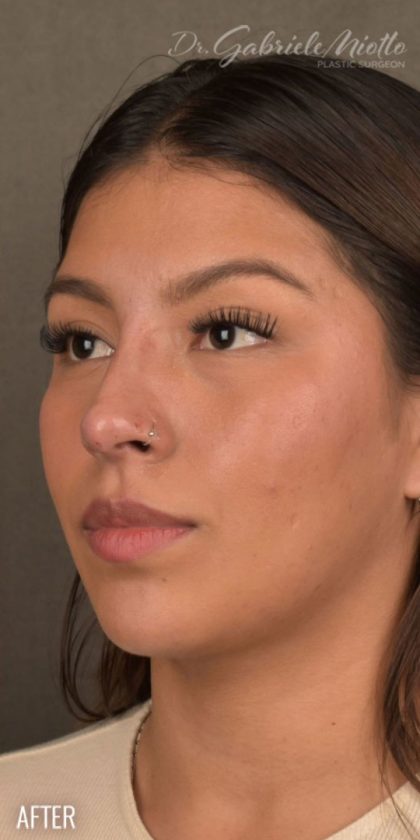 Non Surgical Rhinoplasty Before & After Patient #1313