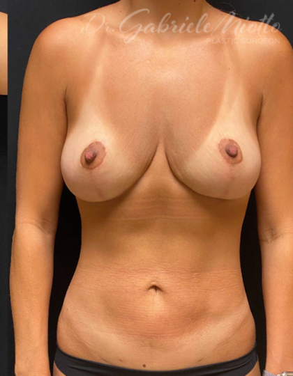 Breast Lift Before & After Patient #1630