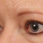 Blepharoplasty Before & After Patient #706