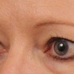 Blepharoplasty Before & After Patient #706