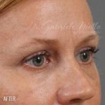 Blepharoplasty Before & After Patient #704