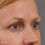 Blepharoplasty Before & After Patient #704