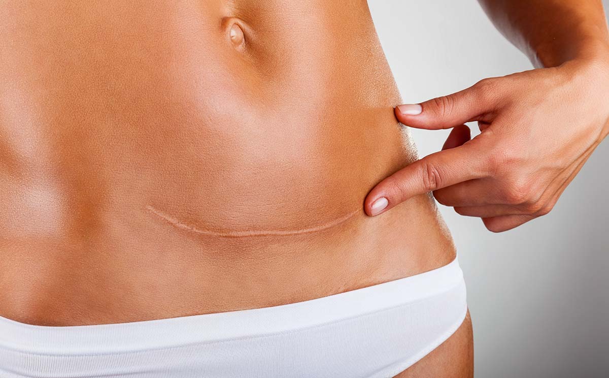 Scar Treatment