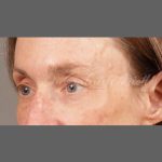 Botox Before & After Patient #1346