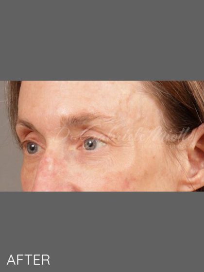 Botox Before & After Patient #1346