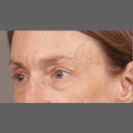 Botox Before & After Patient #1346