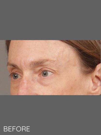 Botox Before & After Patient #1346