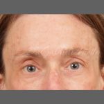 Botox Before & After Patient #1346