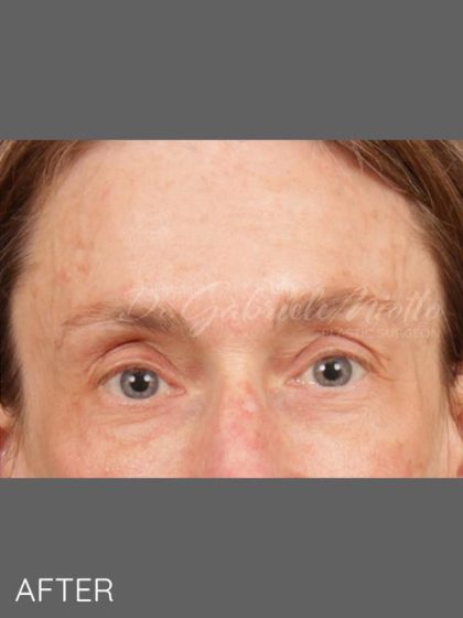 Botox Before & After Patient #1346