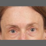 Botox Before & After Patient #1346