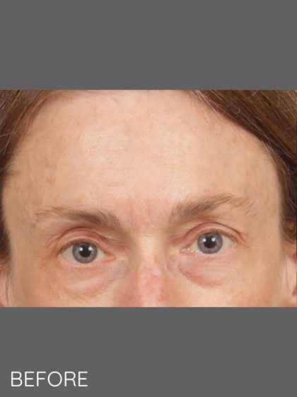 Botox Before & After Patient #1346