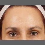 Botox Before & After Patient #1356
