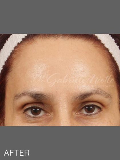 Botox Before & After Patient #1356