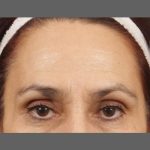 Botox Before & After Patient #1356