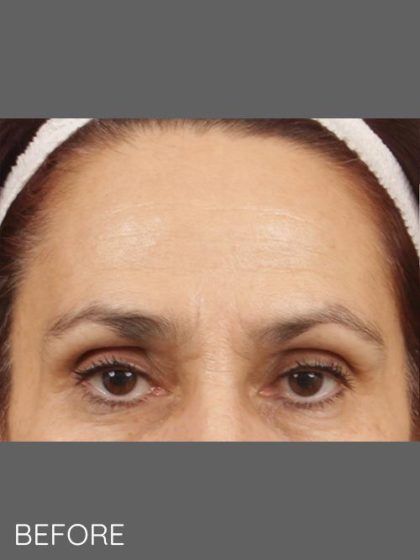 Botox Before & After Patient #1356