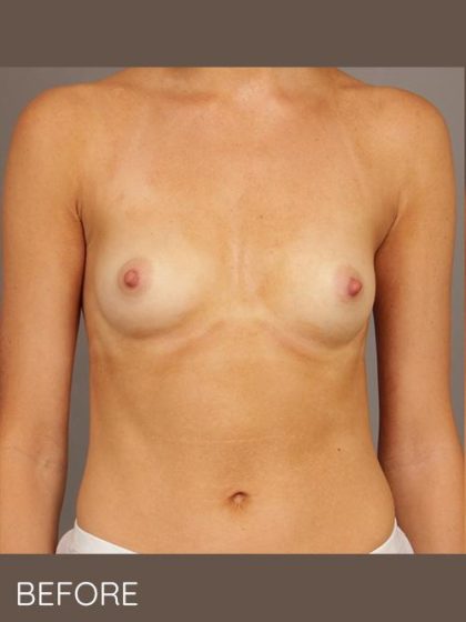 Breast Augmentation Before & After Patient #1499