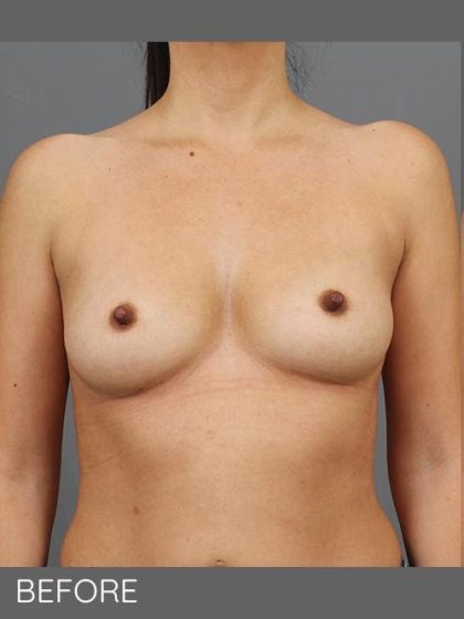 Breast Augmentation Before & After Patient #1501