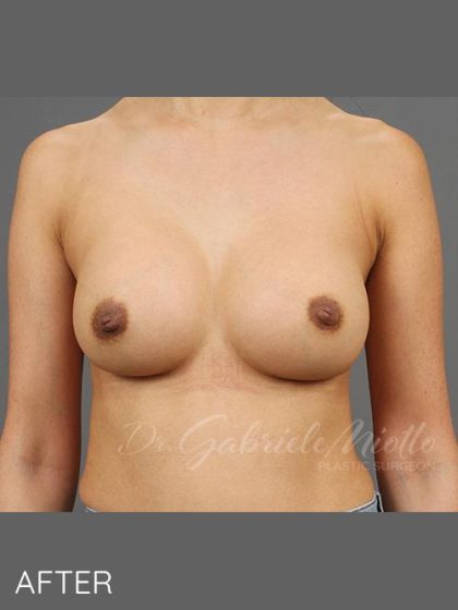 Breast Implant Exchange Before & After Patient #1542