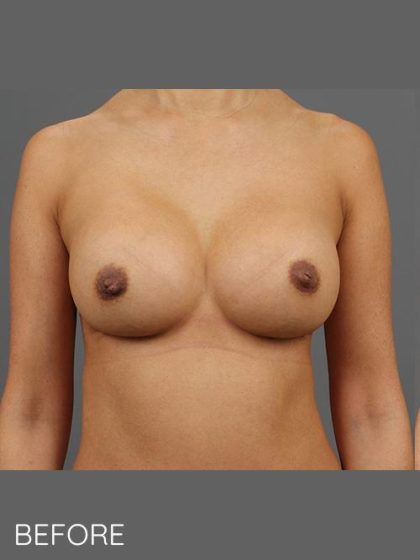 Breast Implant Exchange Before & After Patient #1542