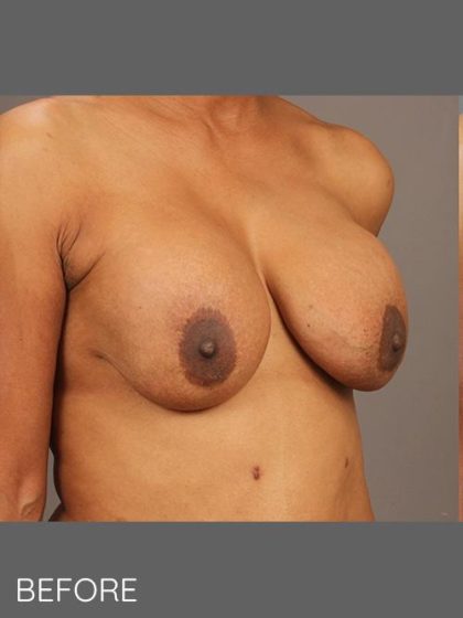 Breast Implant Exchange Before & After Patient #1544