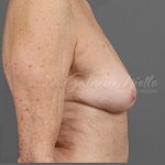 Breast Implant Removal Before & After Patient #1585
