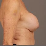 Breast Implant Removal Before & After Patient #1585