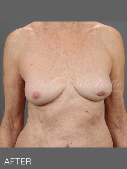 Breast Implant Removal Before & After Patient #1585