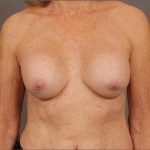 Breast Implant Removal Before & After Patient #1585