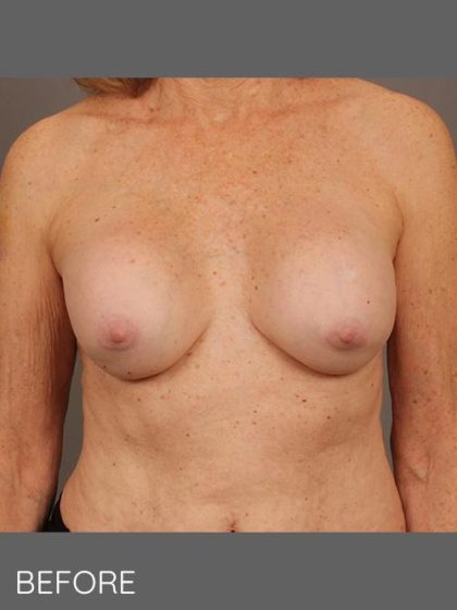 Breast Implant Removal Before & After Patient #1585