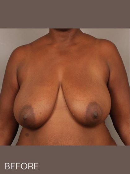 Breast Lift Before & After Patient #1641