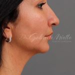 Facial Fat Grafting Before & After Patient #1257