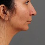 Facial Fat Grafting Before & After Patient #1257