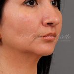 Facial Fat Grafting Before & After Patient #1257