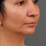 Facial Fat Grafting Before & After Patient #1257