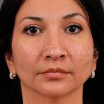 Facial Fat Grafting Before & After Patient #1257