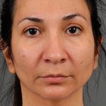 Facial Fat Grafting Before & After Patient #1257