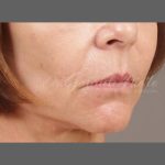 Facial Fat Grafting Before & After Patient #1255