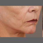 Facial Fat Grafting Before & After Patient #1255