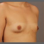 Fat Transfer Breast Augmentation Before & After Patient #1516