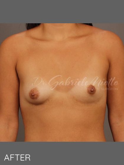 Fat Transfer Breast Augmentation Before & After Patient #1516