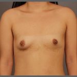 Fat Transfer Breast Augmentation Before & After Patient #1516