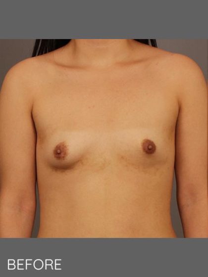 Fat Transfer Breast Augmentation Before & After Patient #1516