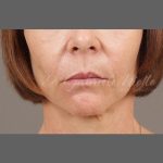 Facial Fat Grafting Before & After Patient #1255
